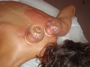 Cupping